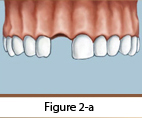 Dental Implants Figure 2-a