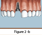 Dental Implants Figure 2-b