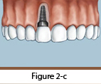 Dental Implants Figure 2-c