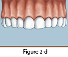 Dental Implants Figure 2-d