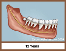 Wisdom Teeth in 12 Years