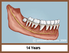 Wisdom Teeth in 14 Years