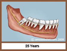 Wisdom Teeth in 25 Years