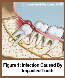 Figure 1 : Infection Caused by Impacted Tooth