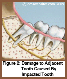 Figure 2 : Damage to Adjacent Tooth Caused By Impacted Tooth